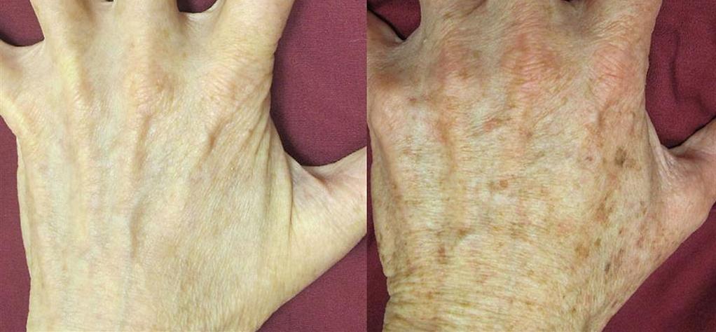 לפני (מימין) ואחרי 3 טיפולים ששילבו טכנולוגיית IPL עם הזרקת ממריצי עור (צילום: ד"ר אופיר ארצי)