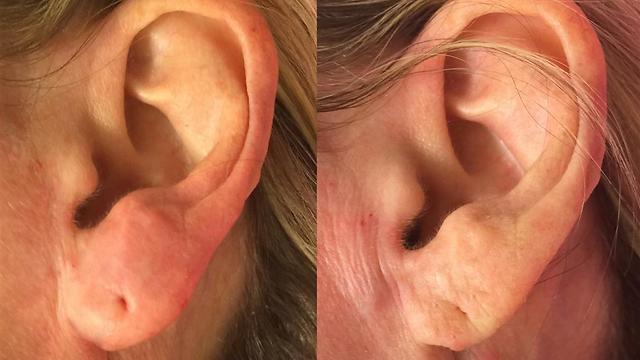 לפני (מימין) ואחרי ניתוח למילוי תנוכי אוזניים  (צילום: ד"ר אופיר ארצי) (צילום: ד