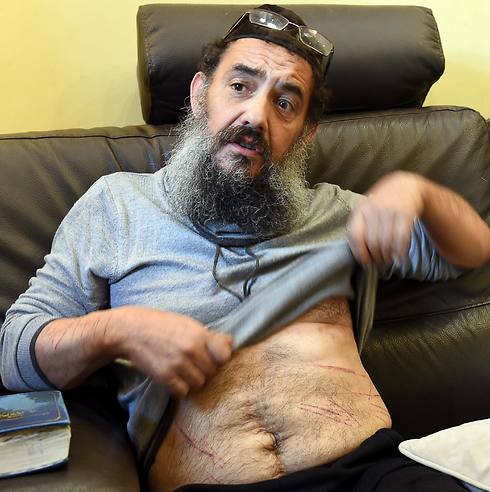 Tzion Saadon displaying the injuries he claims to have sustained in ISIS attack (Photo: AFP)
