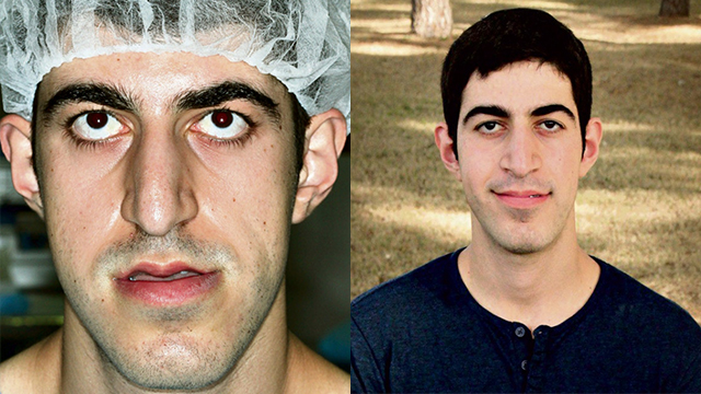 אסאל מור. הניתוח ששינה לו את הפנים