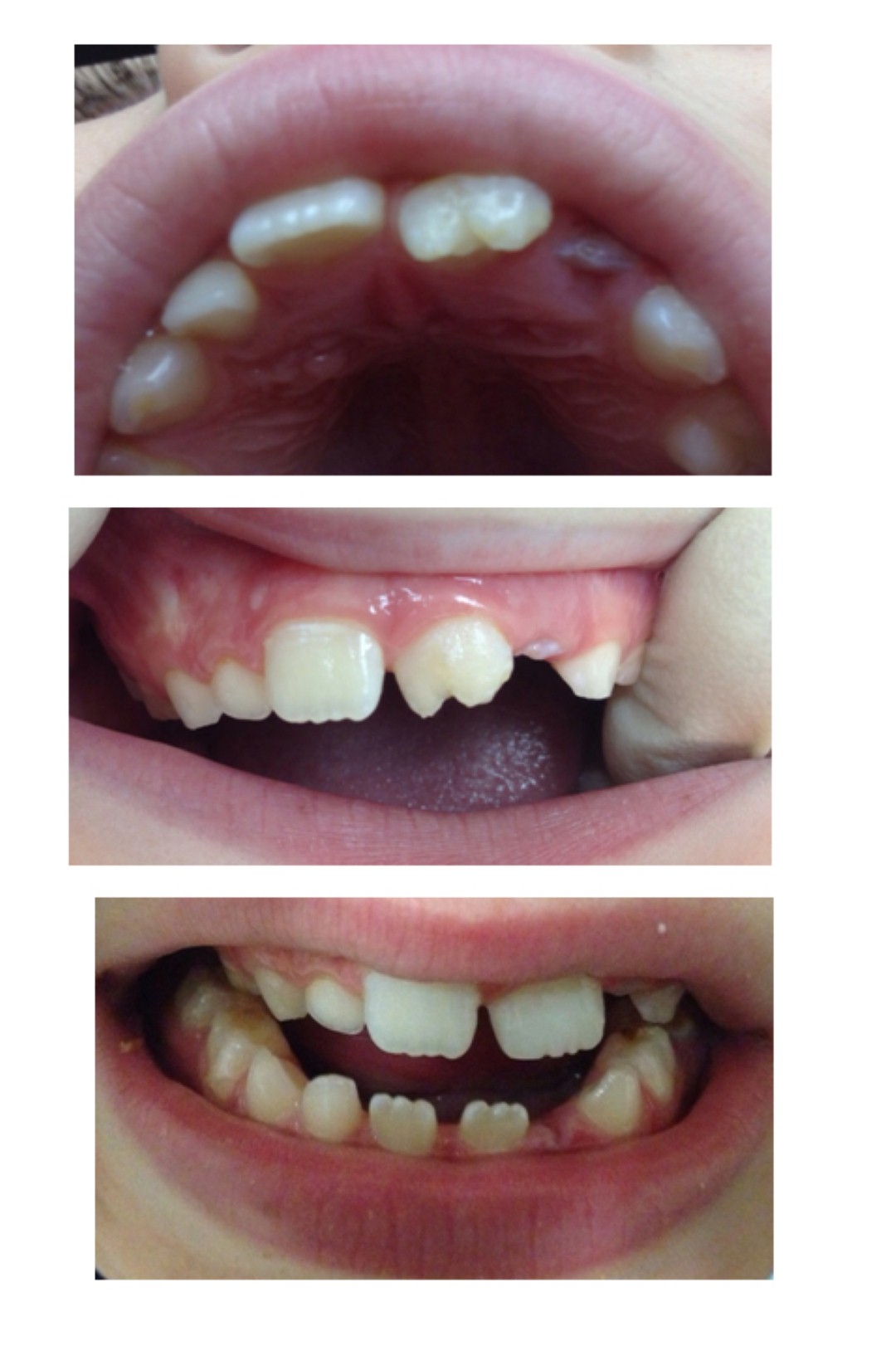 פגיעה בשן קבועה בעקבות חבלה לשן הנשירה ( ) ( )