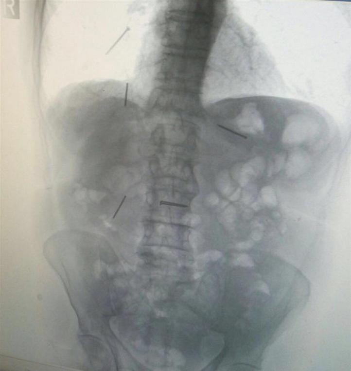 צילום הרנטגן עם המסמרים בגופו של הפועל
