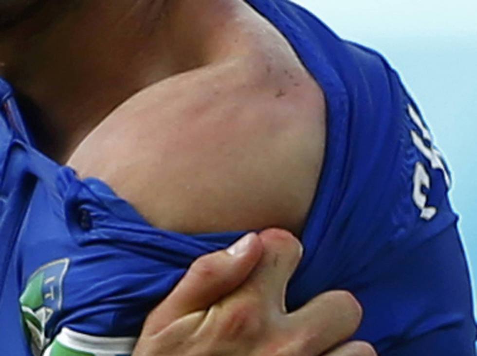 הכתף הפגועה של ג'ורג'יו קייליני אחרי הנשיכה (צילום: רויטרס) (צילום: רויטרס)