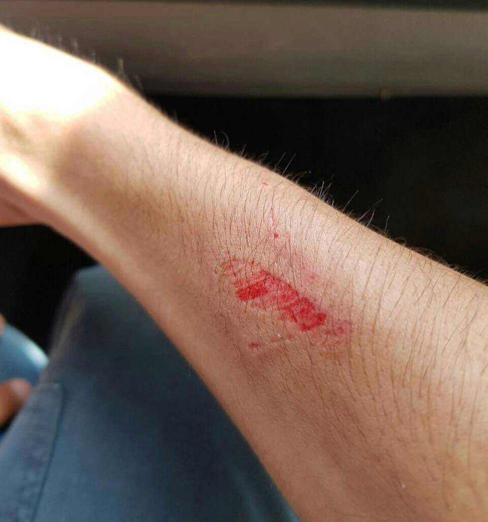 Bite mark on police officer's arm
