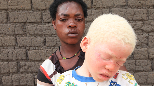 סבל הילדים הלבקנים. מלאווי, אפריקה (צילום: AP) (צילום: AP)