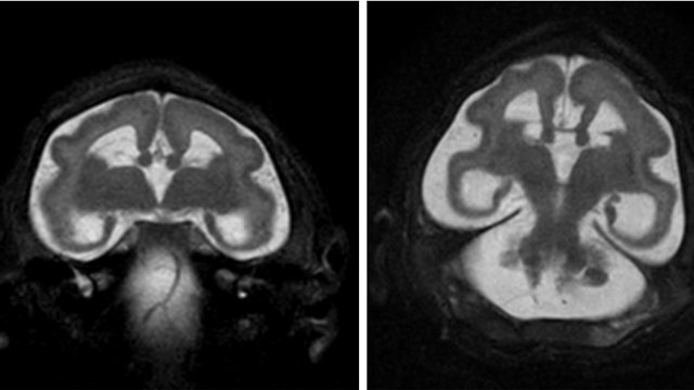 הרחבת חדרים. המוח "מפוצץ" בנוזל שאינו מתנקז (צילום: Radiology) (Radiology) (Radiology)