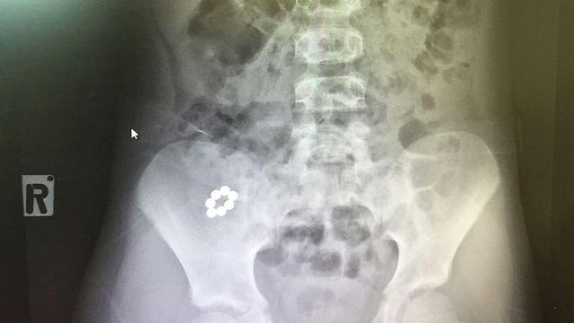 מחרוזת המגנטים הגיעה לבטן התחתונה של הילד (צילום: באדיבות בית החולים רמב"ם) (צילום: באדיבות בית החולים רמב