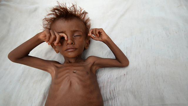 ילד שסובל מתת-תזונה בבית חולים בעיר חודיידה (צילום: רויטרס) (צילום: רויטרס)