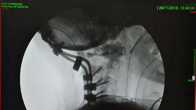 השתל מעצם הזנב הונח על גבי חוליית הצוואר המרוסקת (צילום: בית חולים קפלן) (צילום: בית חולים קפלן)