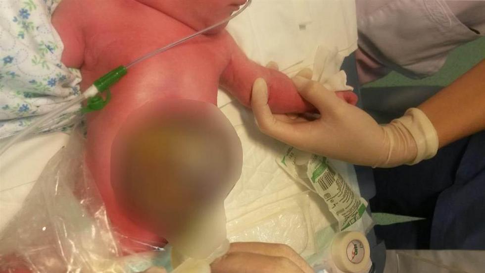 התינוקת לאחר הלידה. המעיים בשק השפיר מחוץ לגוף (  ) (  )