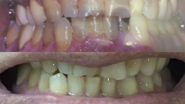בנימין חפץ לפני ואחרי. בתמונה למעלה: הלסת התחתונה לפני הטיפול. למטה: השינוי בלסת התחתונה אחרי - השיניים הישרות (באדיבות: כללית סמייל) (באדיבות: כללית סמייל)