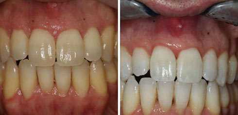 הלבנת שיניים מהירה (צילום: באדיבות מרפאת יודנטל ד״ר אילן פרייס)