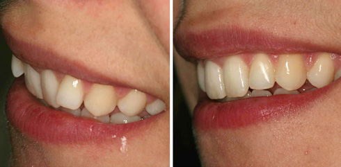 מיישר אינמן. בעיקר לבעיות בשיניים קדמיות (צילום: באדיבות מרפאת יודנטל ד״ר אילן פרייס)