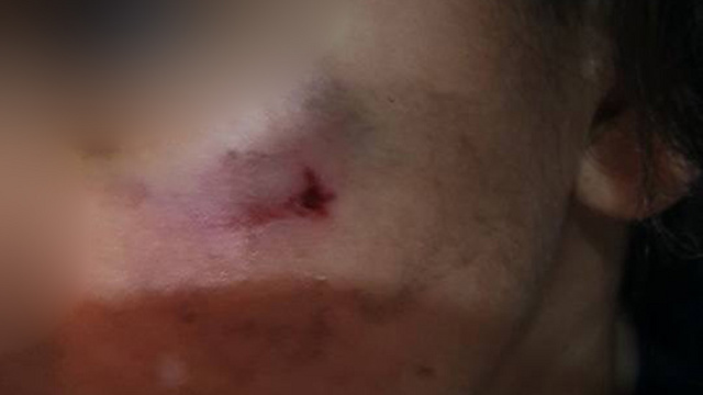 Bruises on Maor's face