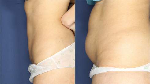 לפני ואחרי. לא חייבים שאיבת שומן קלאסית (צילום: מרפאת ד”ר רונן גלזינגר)