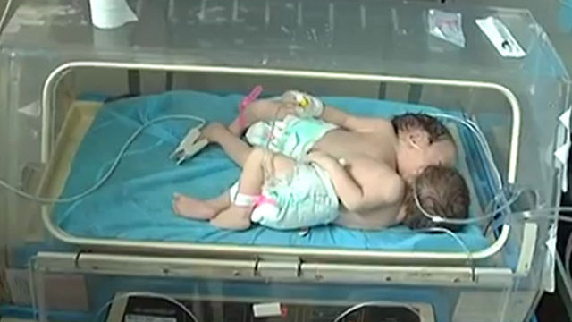 Conjoined Palestinian twins