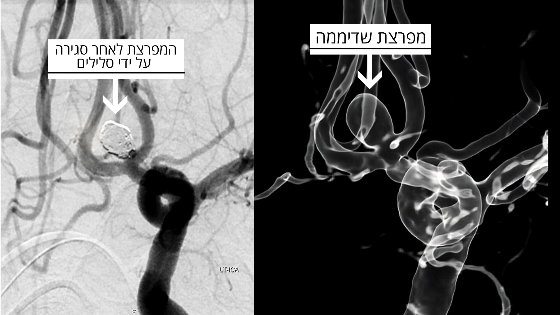 КТ головного мозга моряка до операции и после (справа - кровотечение, слева - аневризма, в котрую ввели спираль. Фото: Петр Плитер