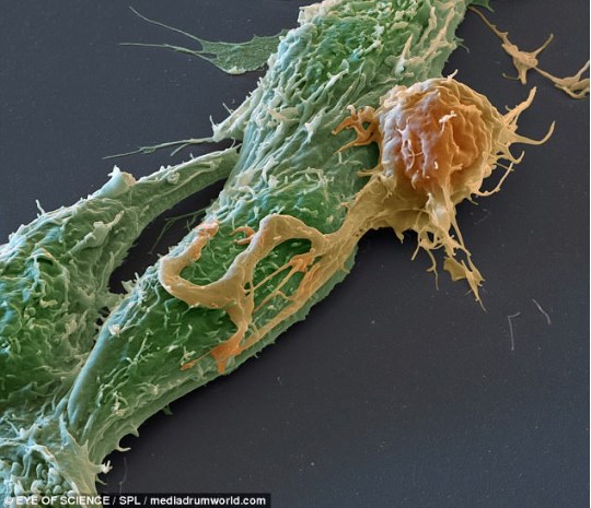 Клетка рака молочной железы (выделена зеленым цветом) подвергается нападению Т-лимфоцита с CAR-рецептором