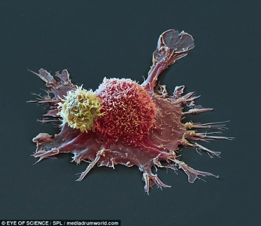 На этом изображении (увеличение в 2600 раз) раковая клетка (выделена розовым цветом) начала распространяться в груди, на нее нападает Т-клетка (желтый)