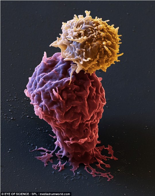 Это микроскопическое изображение показывает клетку рака крови-лейкемии (выделена розовым цветом), которую атакует Т-клетка непосредственно перед появлением новых лейкозных клеток