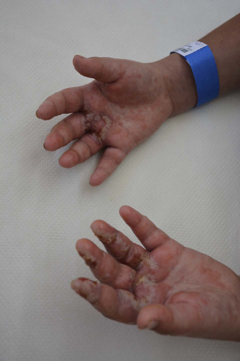 Руки Шахар Бускилы. Фото: пресс- служба больницы "Ха-Эмек"