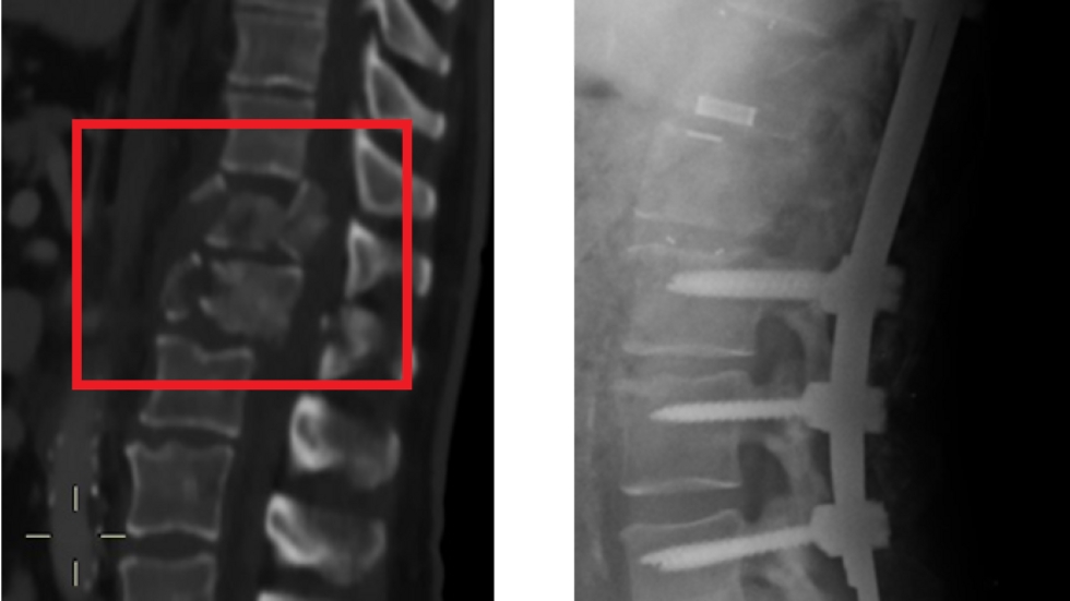 מימן: עמוד השדרה של אילן לאחר הניתוח. משמאל: החוליות המרוסקות (מוקפות באדום) (צילום: ביה"ח בילינסון) (צילום: ביה