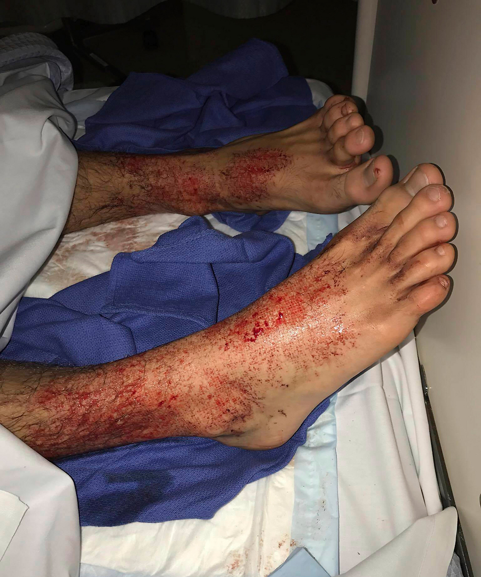 הרגליים של סם אחרי התקיפה (צילום: AP) (צילום: AP)