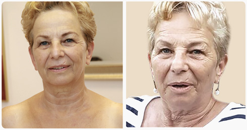 ניתן להבחין בשינויים שחלו במראה הצוואר בעקבות הטיפול (צילום: מירי קרן ורפי דלויה)
