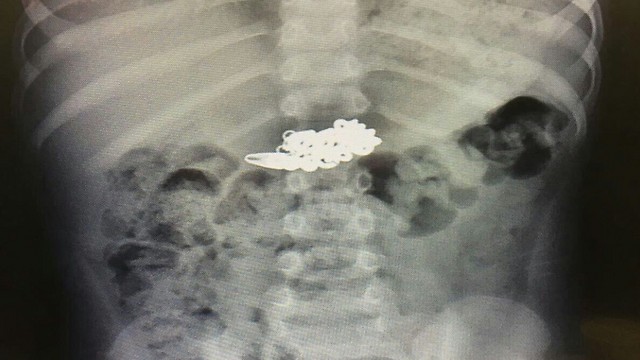 הרנטגן שאישר כי הילד בלע את השרשרת (צילום: דוברות רמב"ם) (צילום: דוברות רמב