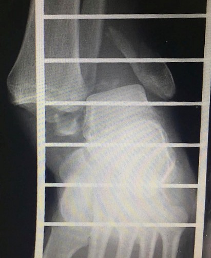 שבר פריקה של הקרסול כפי שנראה בצילום רנטגן