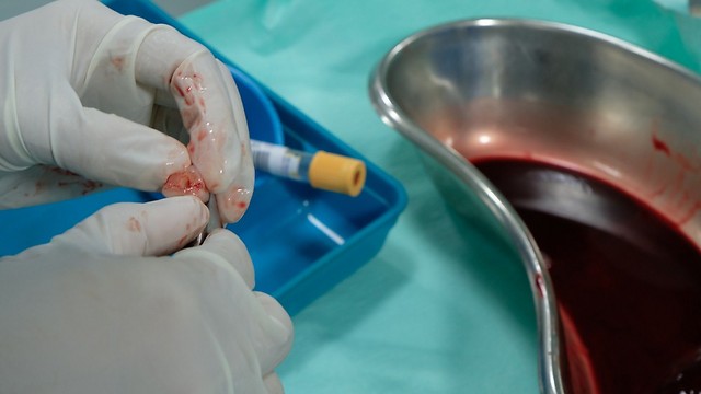 Сбор пуповинной крови в родильной палате. Фото: shutterstock