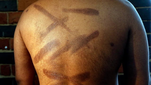 אחד הקורבנות עם כוויות בגבו (צילום: AP) (צילום: AP)