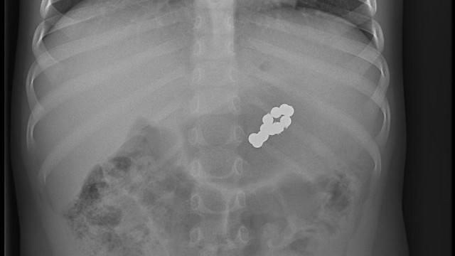 צילום רנטגן של המגנטים במעיים. החרוזים יצרו טבעת ()