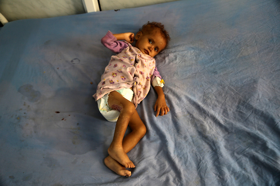 תינוק שסובל מתת-תזונה בחודיידה, תימן (צילום : AFP) (צילום : AFP)