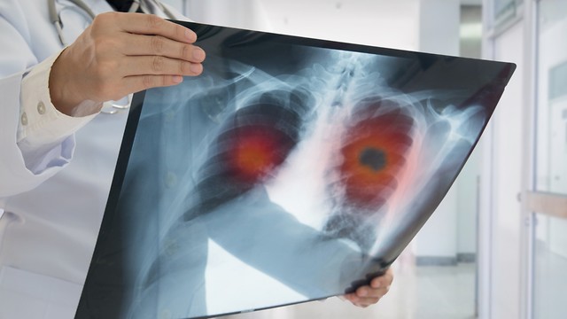 טיפול שנותן לחולי סרטן ריאה בשלב מתקדם (צילום: shutterstock) (צילום: shutterstock)