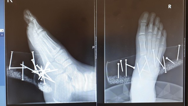צילום רנטגן של רגלו של הילד עם המסמרים (צילום: מרכז רפואי זיו)
