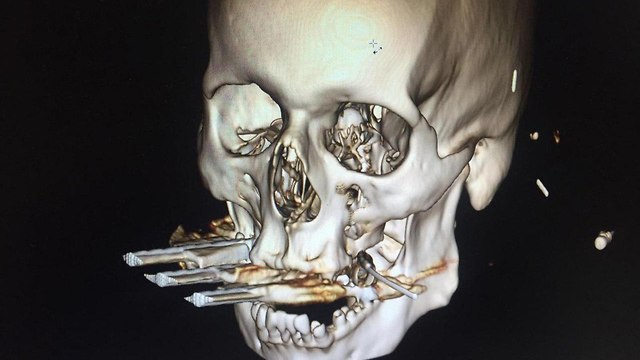 Томография черепа пострадавшего