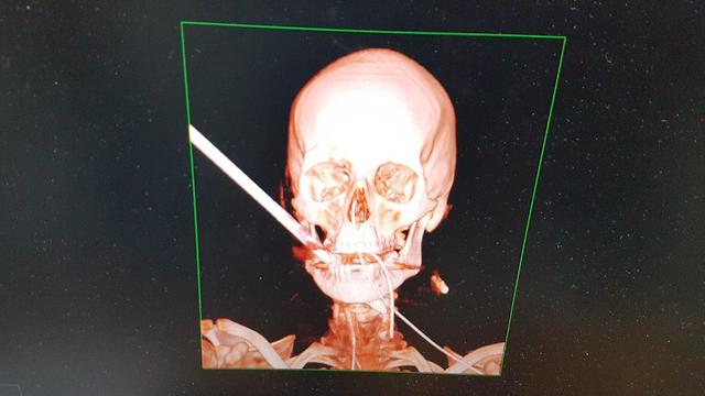 חץ נורה לראשו של תושב עתלית על ידי הנרצח בהתנקשות בעכו (צילום: בית חולים כרמל)