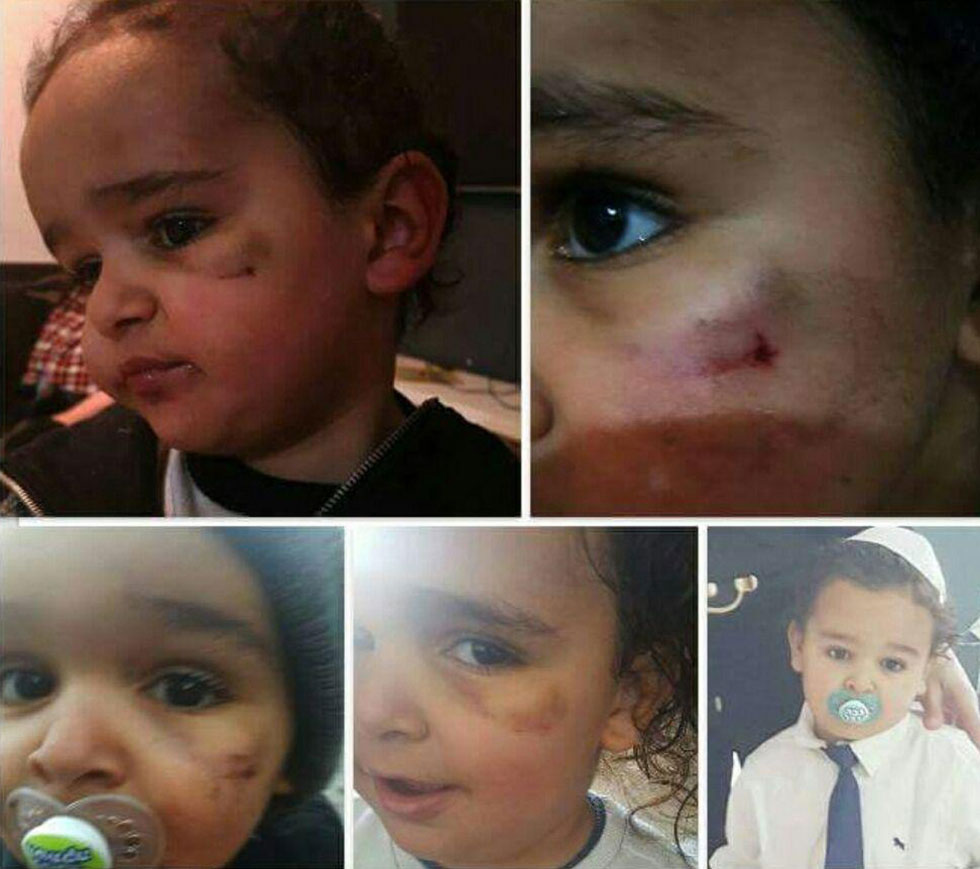 Маор Бен-Абу получил травму в детском саду