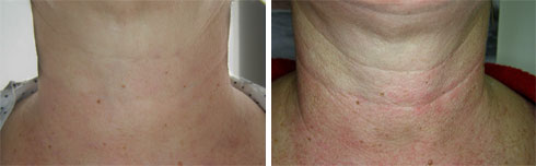 לפני (מימין) ואחרי טיפול בצוואר (צילום: ד״ר ארד) (צילום: חברת PerfAction)