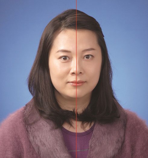 טיפול אידיאלי למתיחת פנים ללא ניתוח (צילום: ד״ר קים, קוריאה) (צילום: חברת PerfAction)