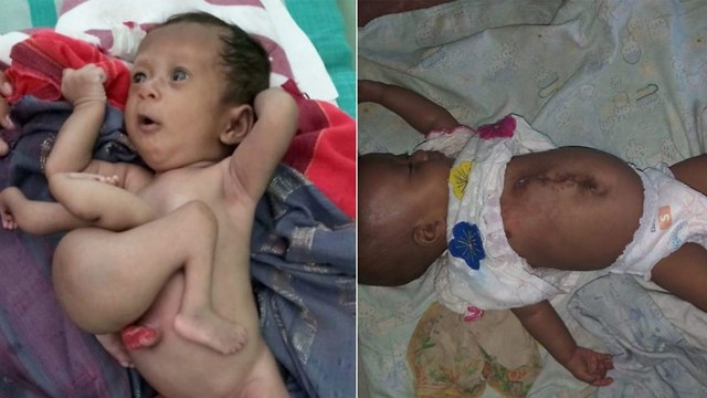 Малышка из Индии до и после операции. Фото: SWNS