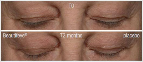 *Beautifeye® - הרכיב הפעיל במסכת העיניים של אייג' קונטרול, לטיפול 360° סביב העיניים (צילום: ד"ר פישר)