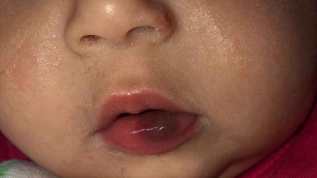 סימני האלימות על שפתיה של התינוקת ()