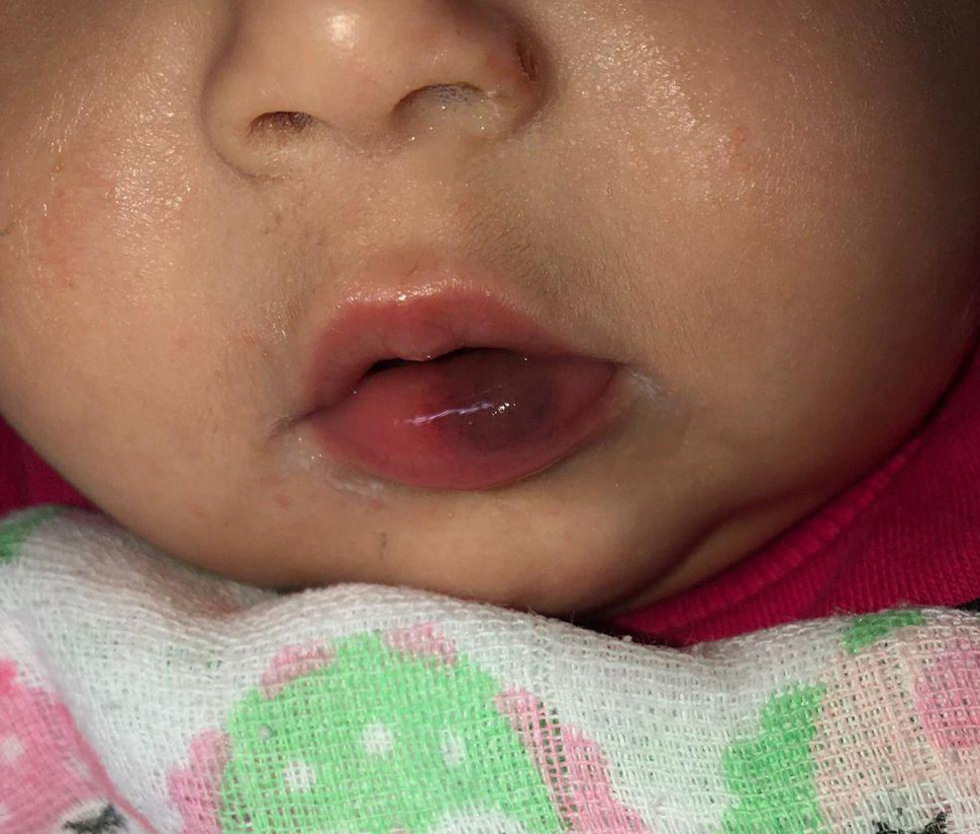 סימני האלימות על שפתיה של התינוקת ()