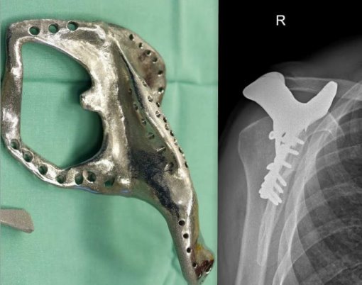 Рентгеновский снимок с вживленным протезом и сам протез. Фото: пресс-служба больницы "Гилель Яфе"