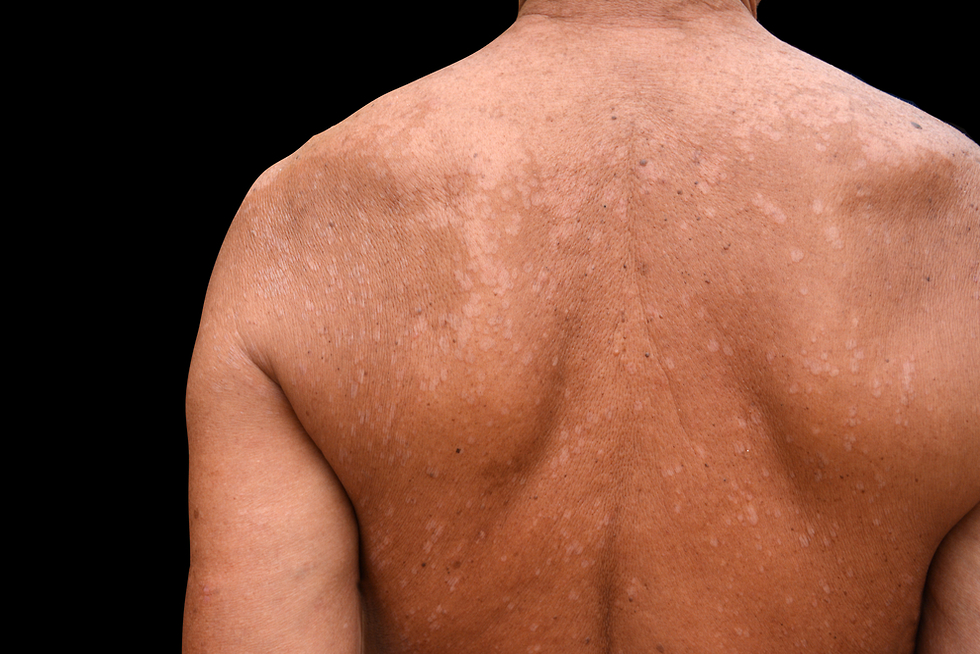 Лечение грибковых заболеваний на кожном покрове тела