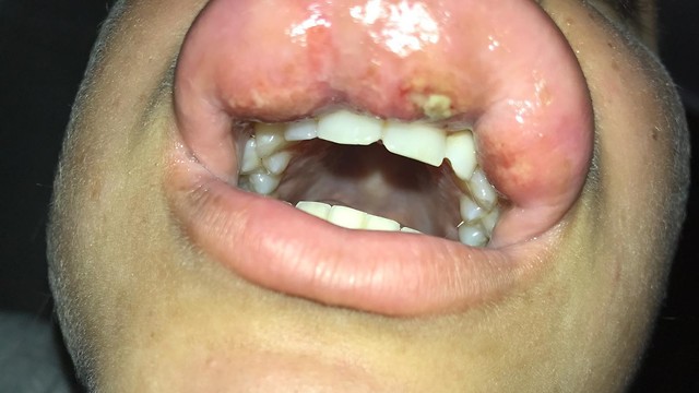 В губе все еще есть остатки введенного вещества, и она сильно болит. Фото: личный альбом