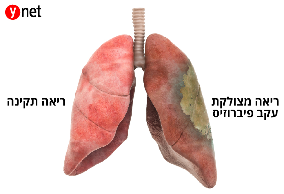 הצטלקות של חלק מרקמת הריאה (צילום: shutterstock)