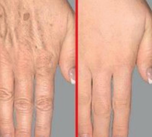חשוב לא פחות לדאוג גם להצערת עור כפות הידיים (צילום: מרפאת ד"ר עמי איל)